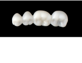 Cod.E2LOWER RIGHT: 15x  posterior hollow wax veneers-bridges, MEDIUM, (44-47), with precarved occlusion to Cod.E2UPPER RIGHT, and compatible to Cod.S2LOWER RIGHT (solid), (44-47)
